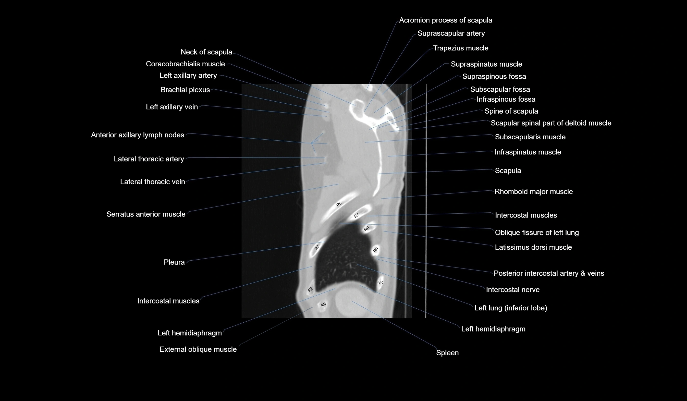 CT chest (thorax) labelled sagittal cross sectional anatomy radiology image-00130.webp